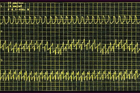 EKG screen display